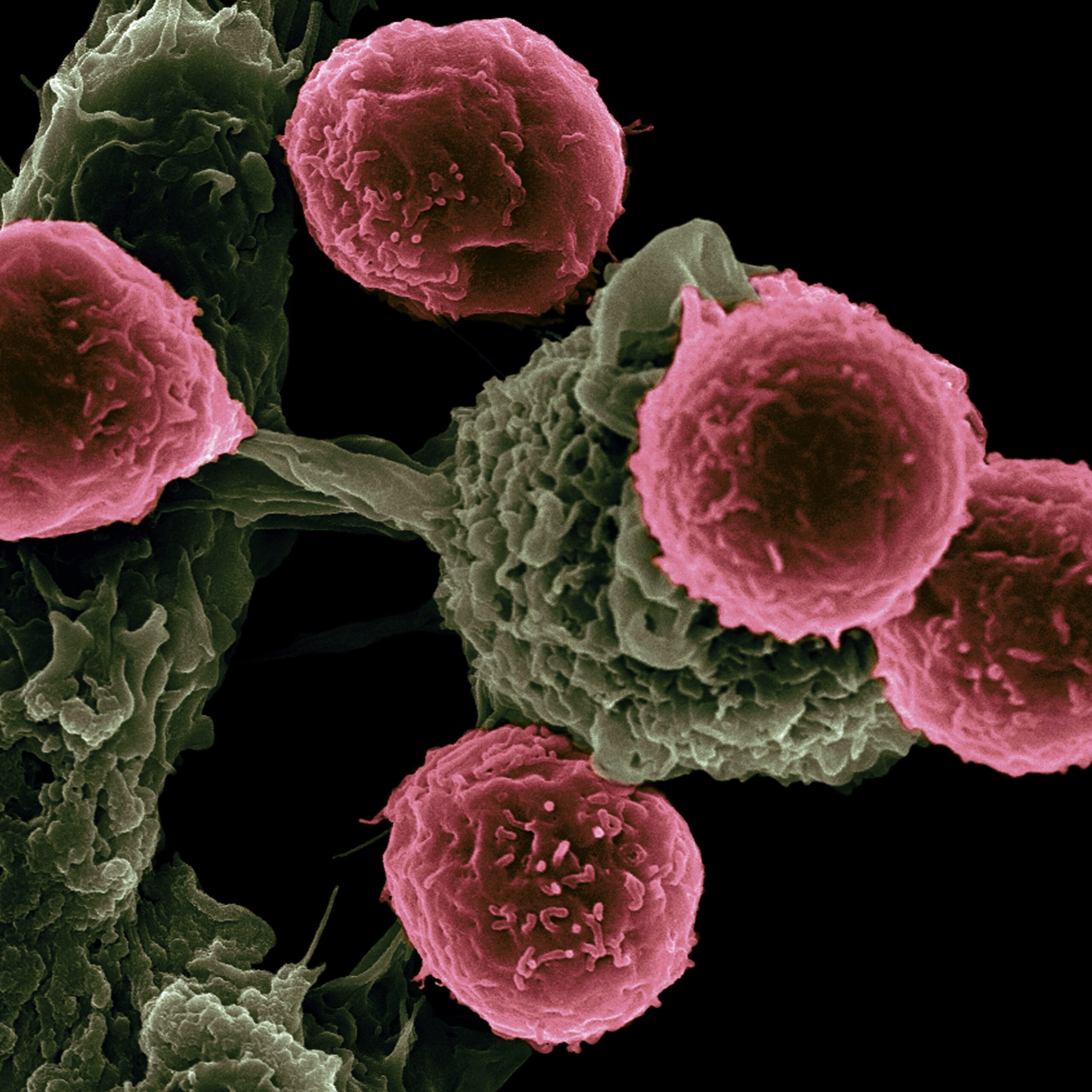 Pesquisadores descobrem proteínas que fazem o câncer resistir à medicação e crescer Pesquisadores descobrem proteínas que fazem o câncer resistir à medicação e crescer